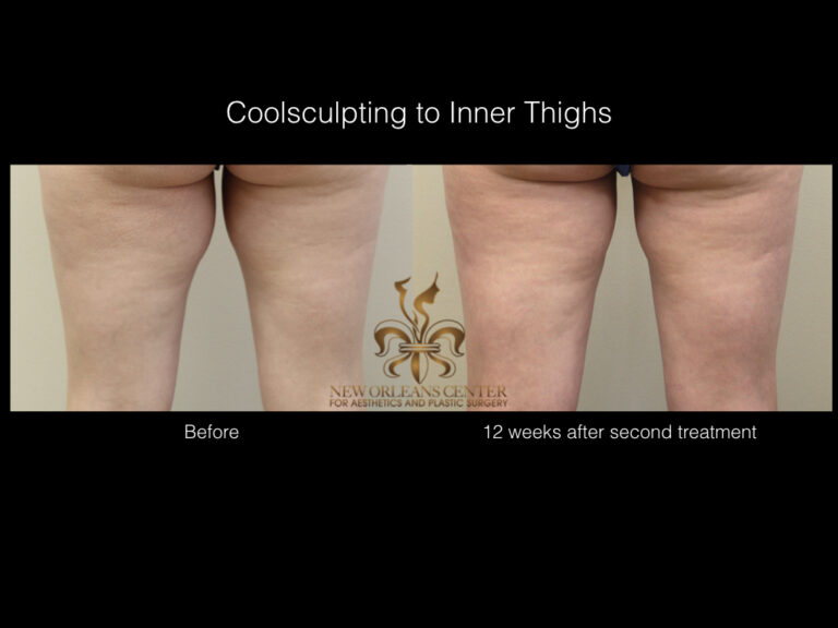 CoolSculpting before and after