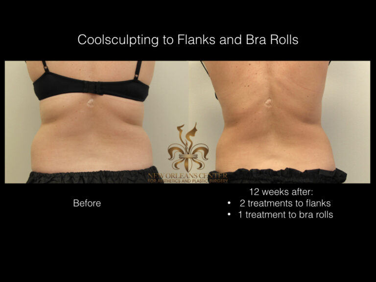 CoolSculpting before and after
