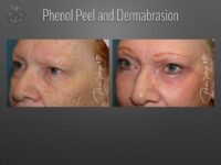 dermabrasion before and after