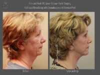 dermabrasion before and after