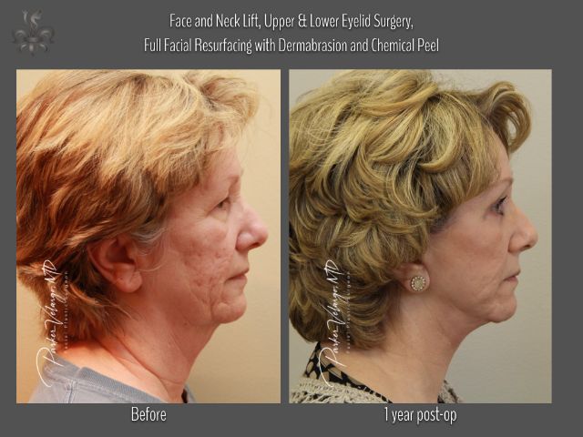 dermabrasion before and after