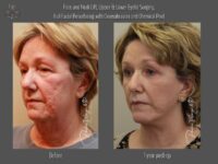 dermabrasion before and after