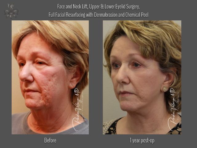 dermabrasion before and after