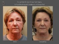 dermabrasion before and after
