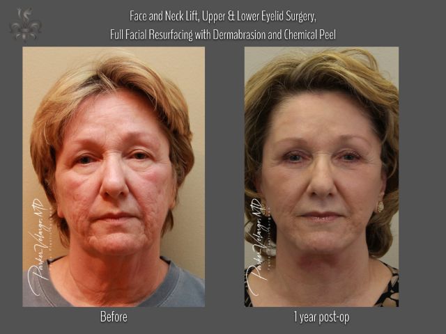 dermabrasion before and after