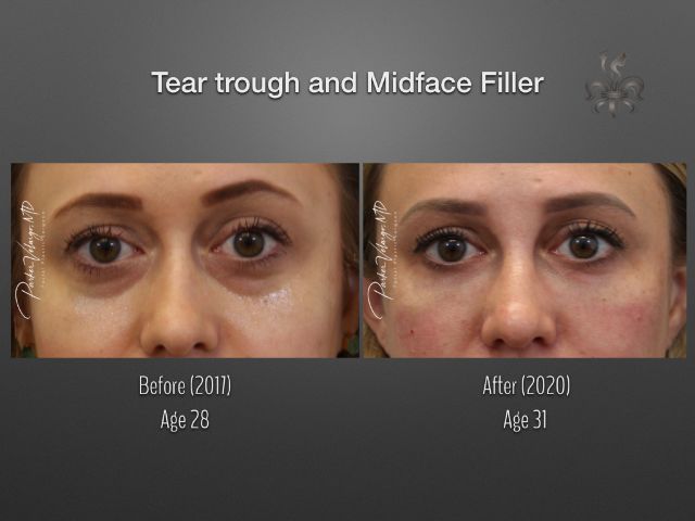 dermal fillers before and after