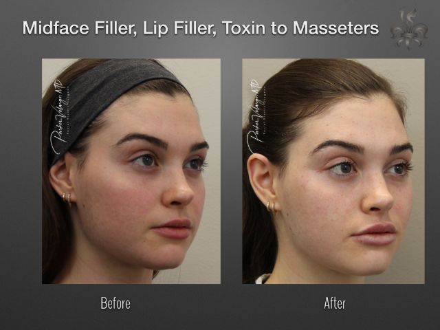 dermal fillers before and after
