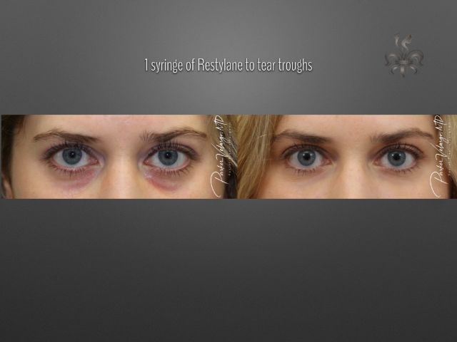 dermal fillers before and after