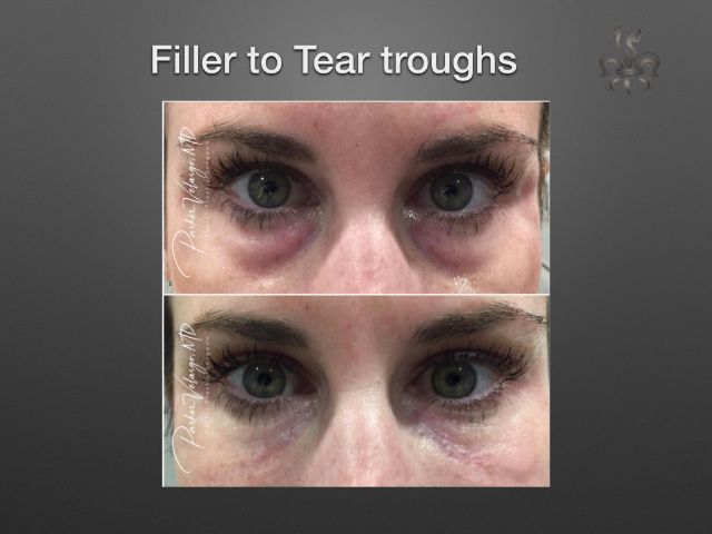 dermal fillers before and after