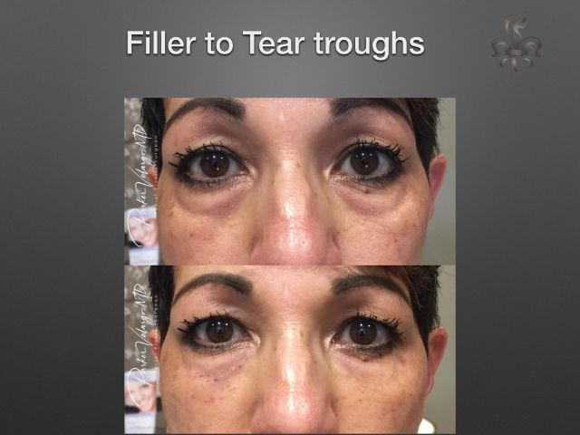 dermal fillers before and after