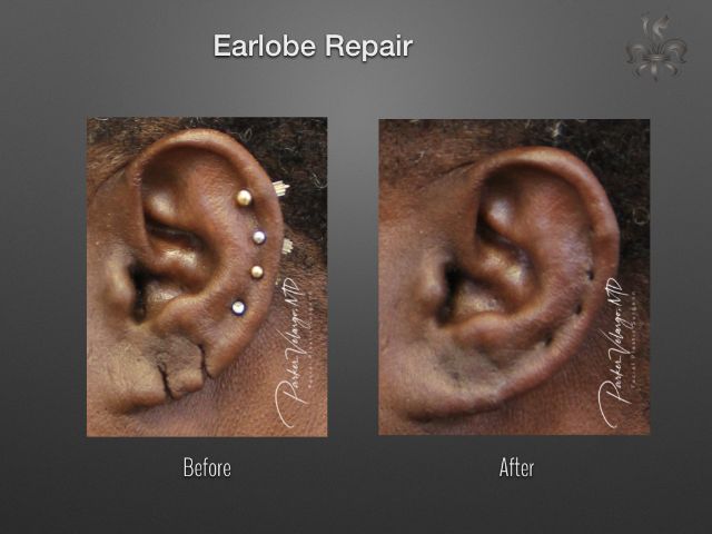 earlobe repair before and after