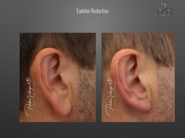 earlobe repair before and after