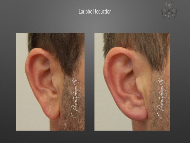 earlobe repair before and after