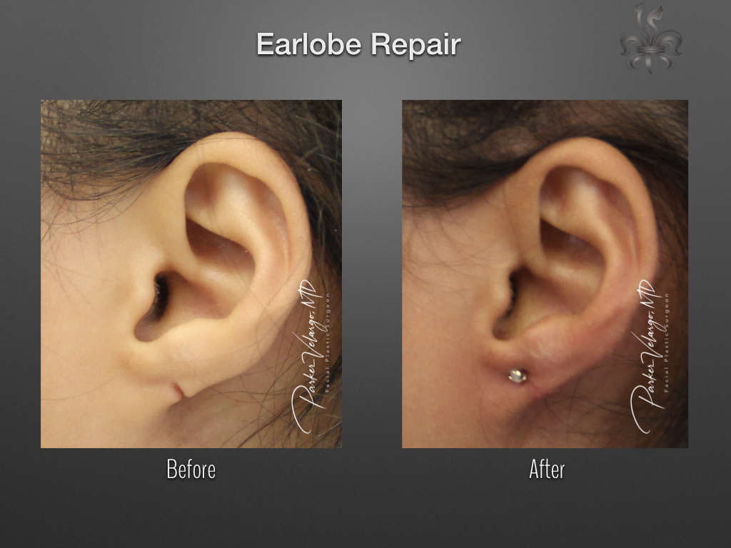 earlobe repair before & after