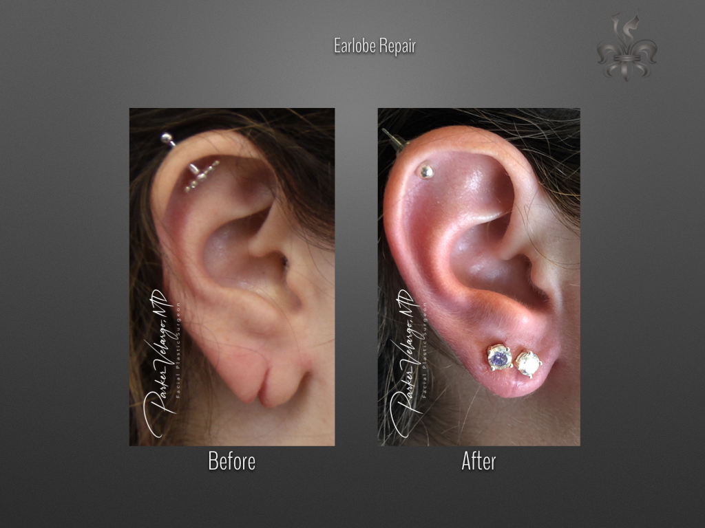 earlobe repair before & after