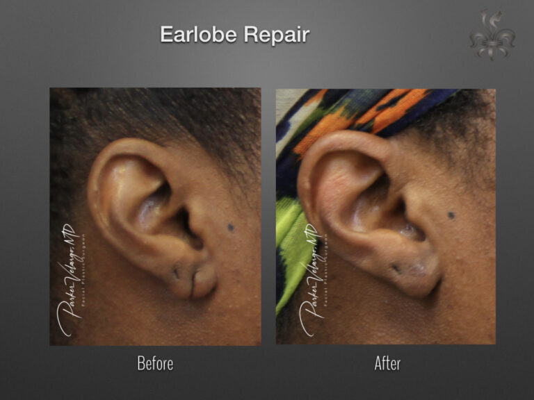earlobe repair before & after