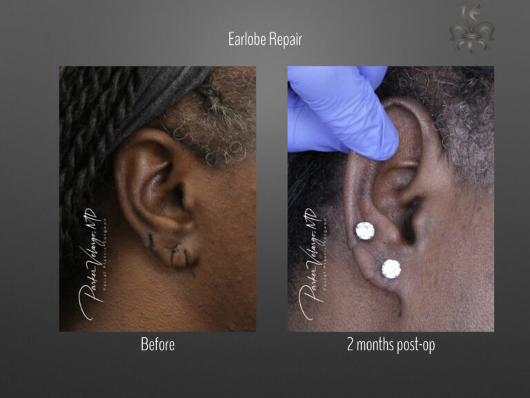 earlobe repair before & after