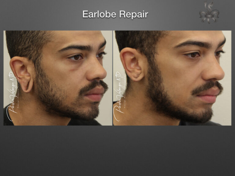 earlobe repair before & after