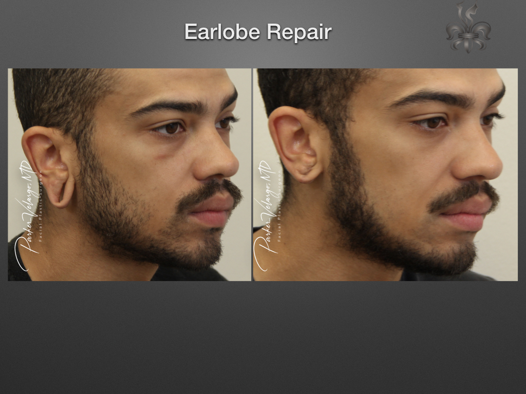 earlobe repair before & after