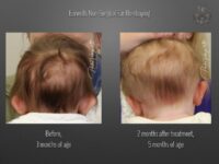 earwells before and after