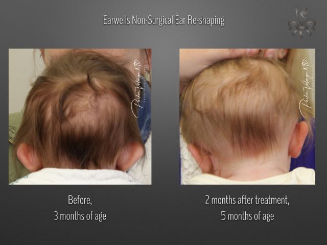 earwells before and after