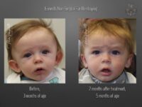 earwells before and after