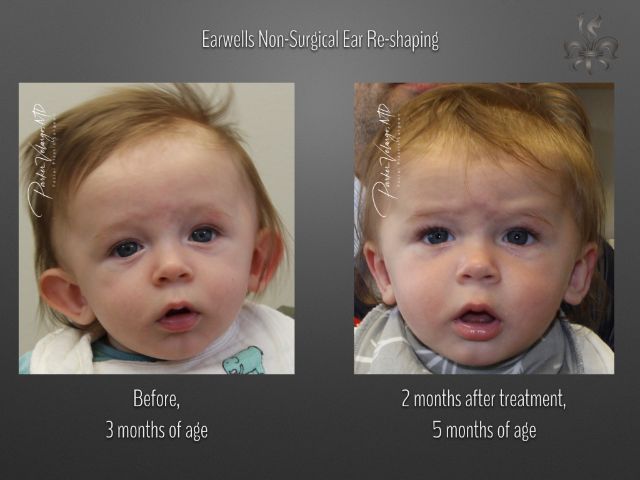 earwells before and after