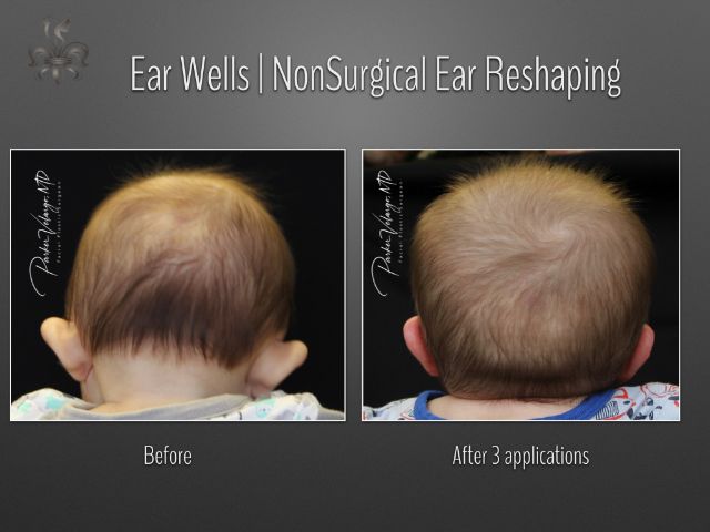 earwells before and after