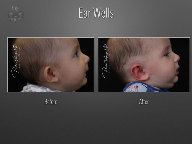 earwells before and after