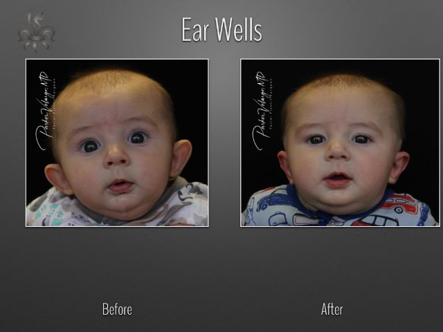 earwells before and after
