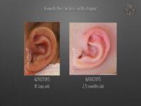 earwells before and after