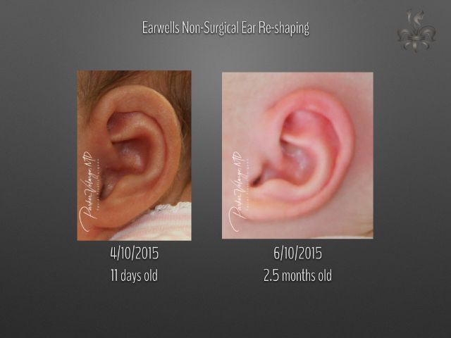 earwells before and after