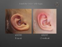 earwells before and after