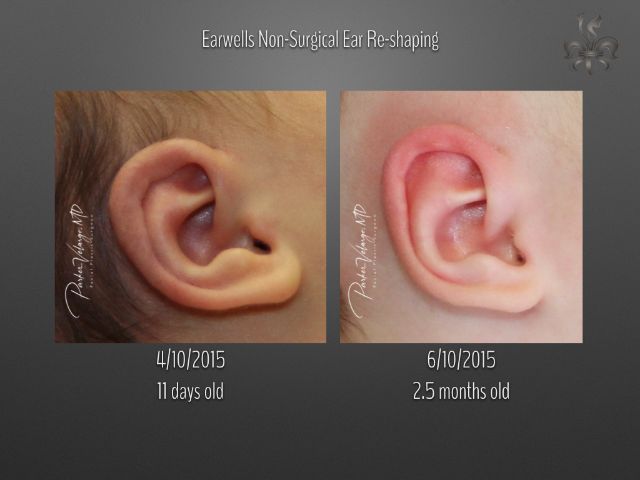 earwells before and after