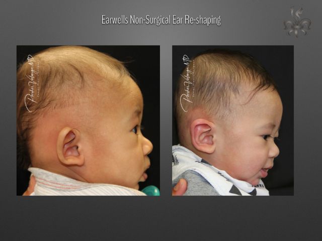earwells before and after