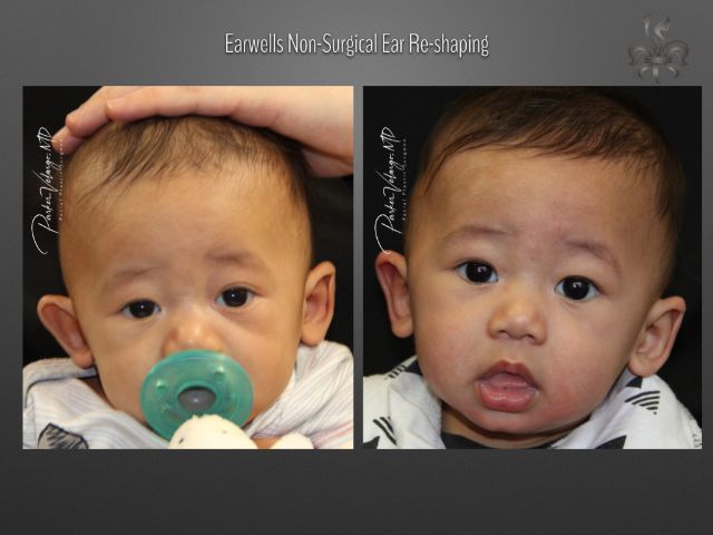 earwells before and after