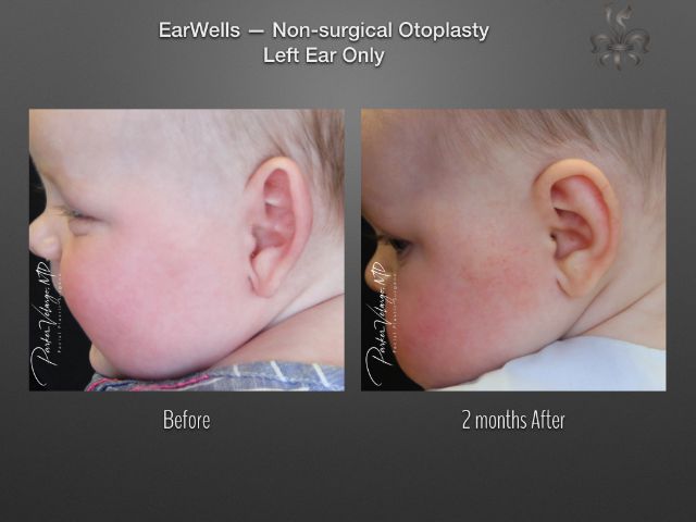 earwells before and after