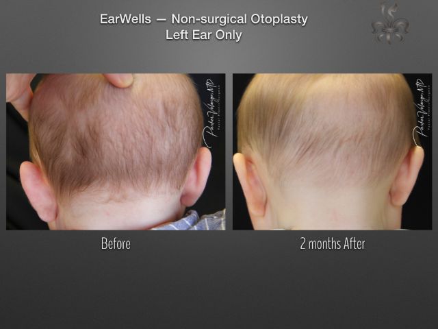 earwells before and after