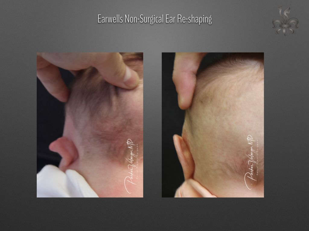 earwells before & after