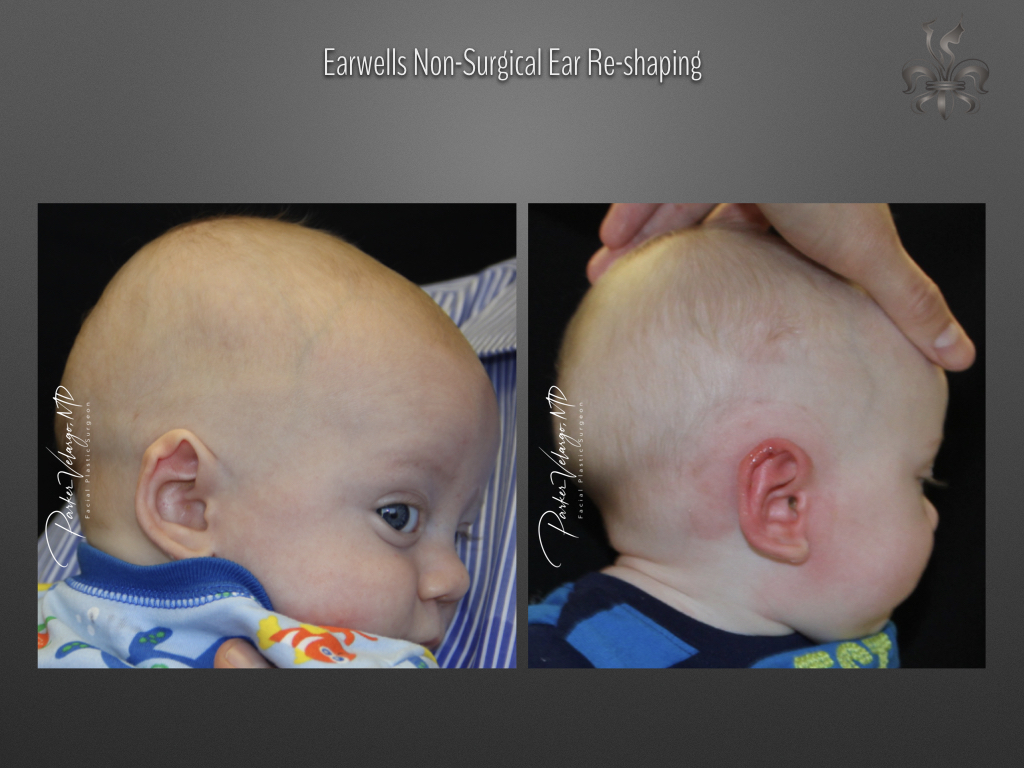 earwells before & after