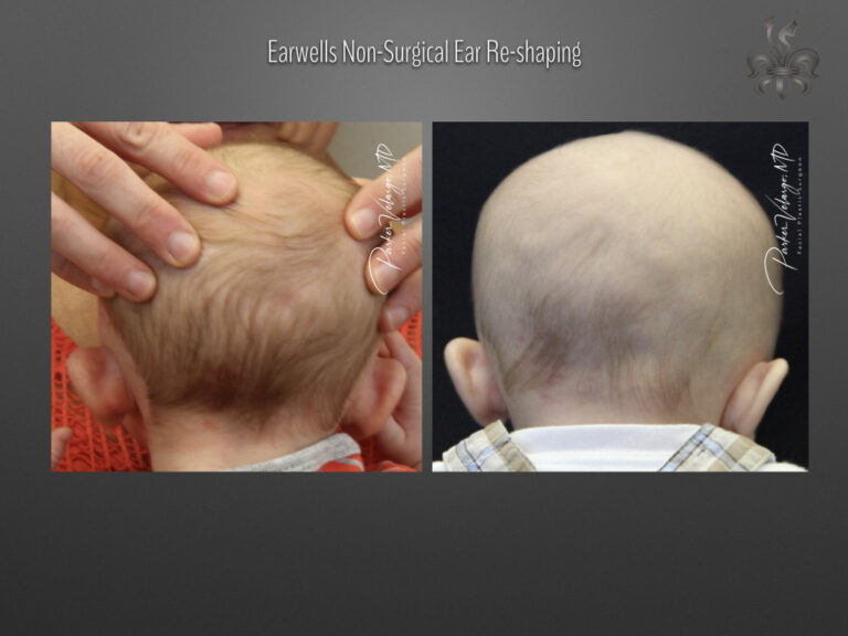 earwells before & after