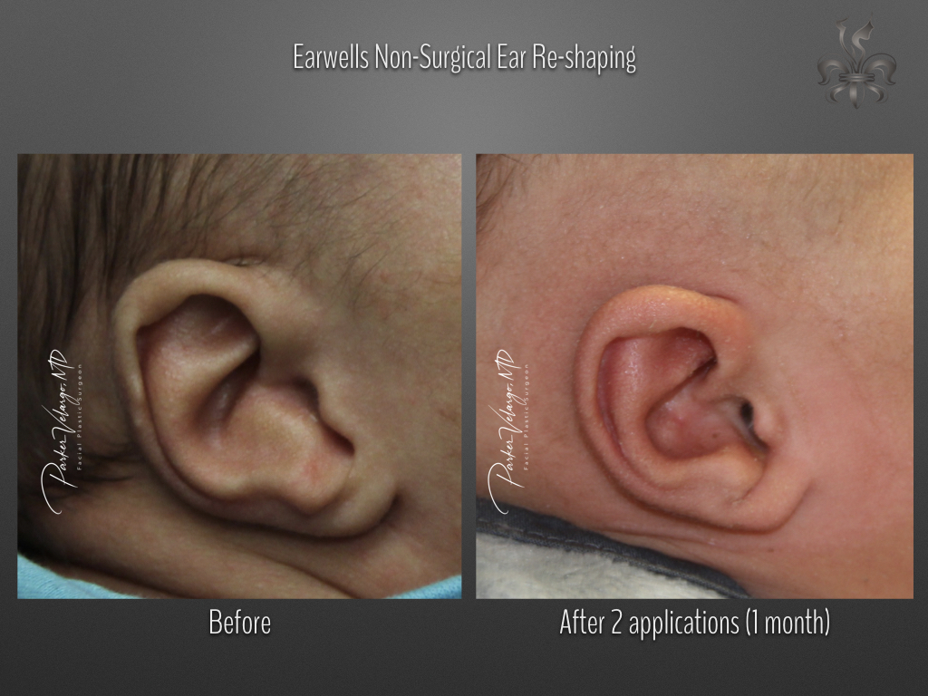 earwells before & after