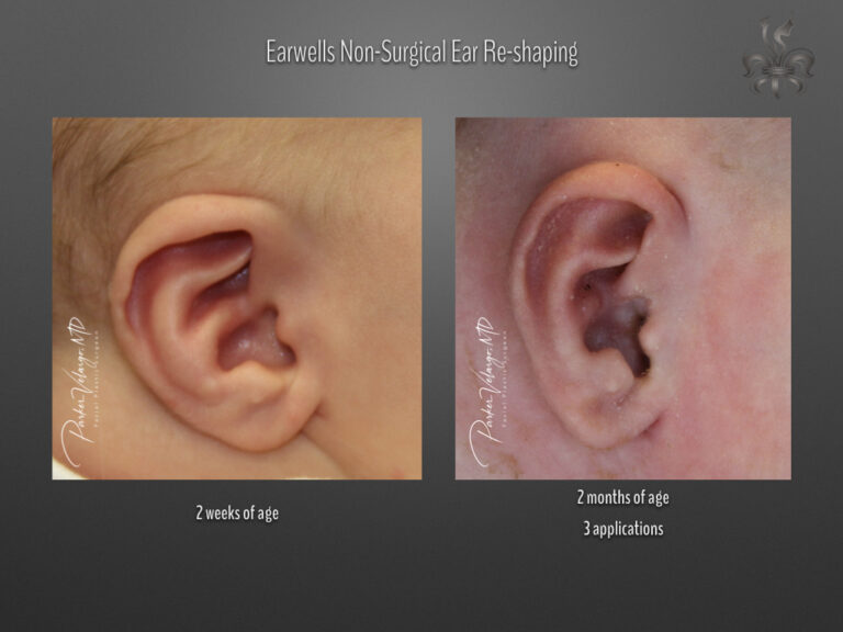 earwells before & after