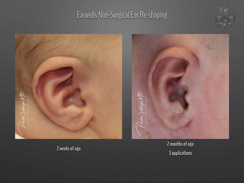 earwells before & after