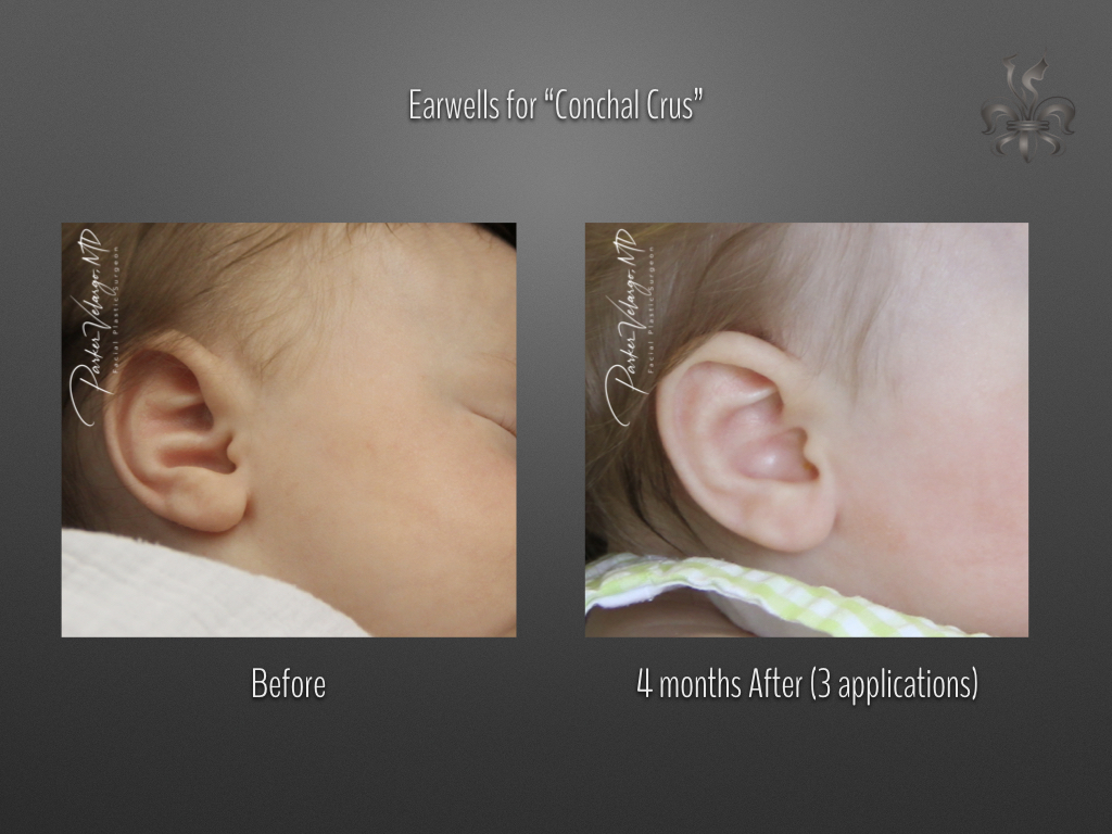 earwells before & after