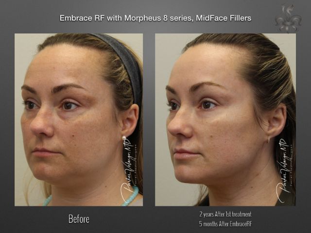 EmbraceRF before and after