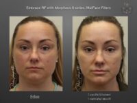 EmbraceRF before and after