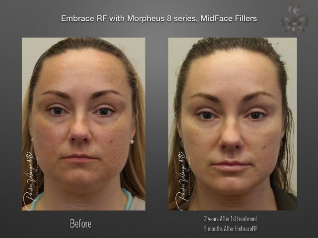 EmbraceRF before and after