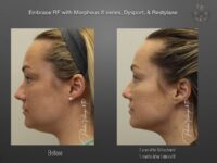 EmbraceRF before and after