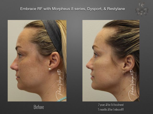 EmbraceRF before and after